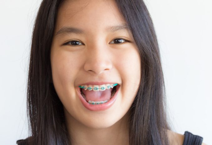  Braces and aligners