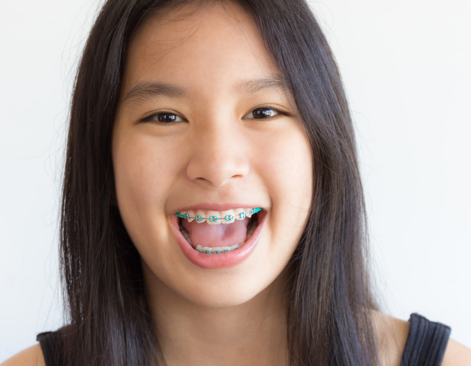 Braces and aligners