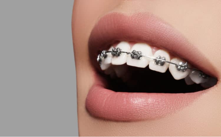  Dental Braces and Aligners: Types, Care, What to Expect