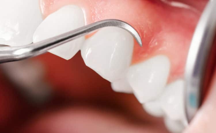  Advanced Gum Treatment for Gum Disease