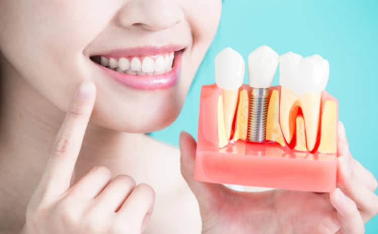  Dental Implants Procedure, Cost, Types, Problems & Safe
