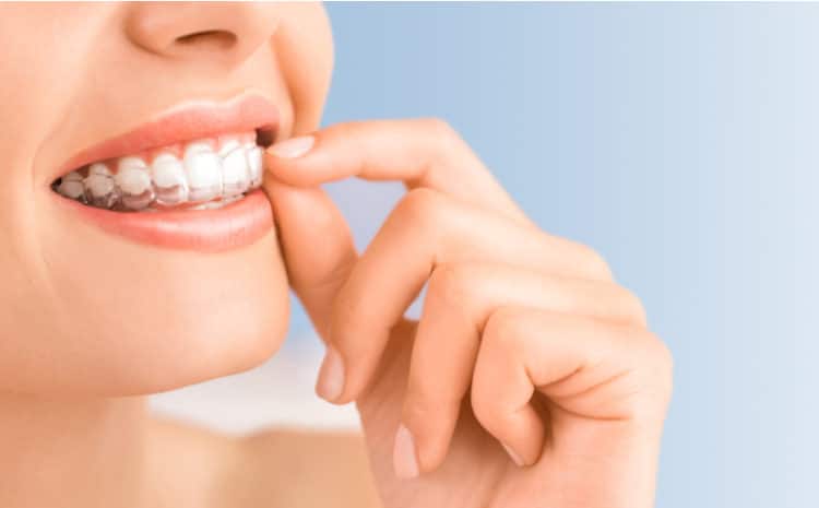  What are Clear Aligners/ Invisalign? How They Work