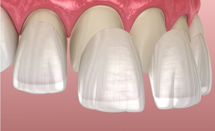  Dental Crowns: What Are They, Types, Procedure & Care