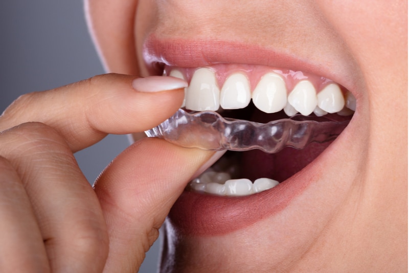  Ortho treatment for teeth – an Affordable and Effective Solution for Teeth Loss