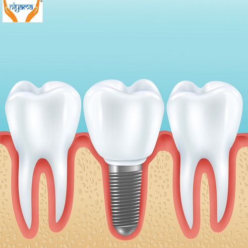  Dental Implants – their uses and benefits