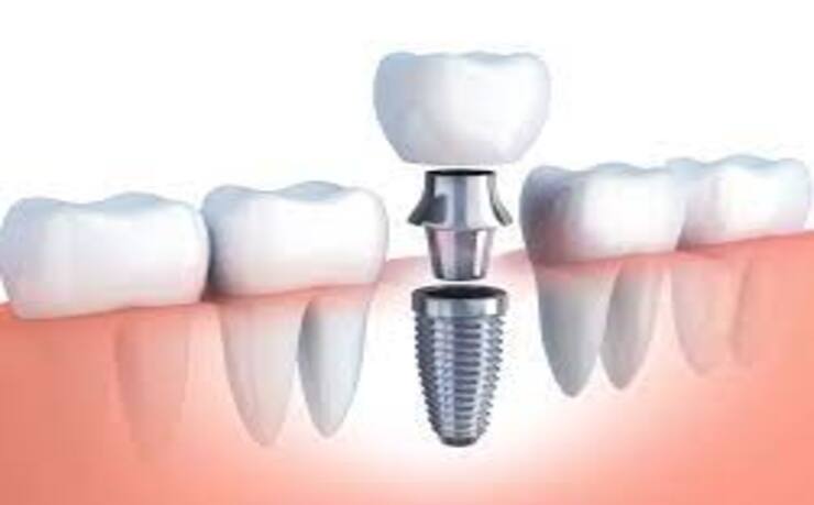  Bring your vibrant smile back with same day dental implants