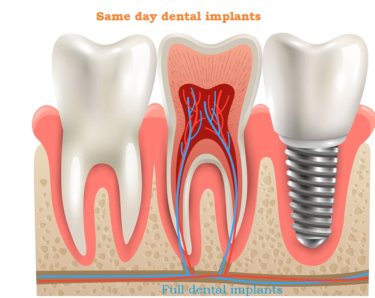  Same day dental implants – Augment your smile with pearly white teeth